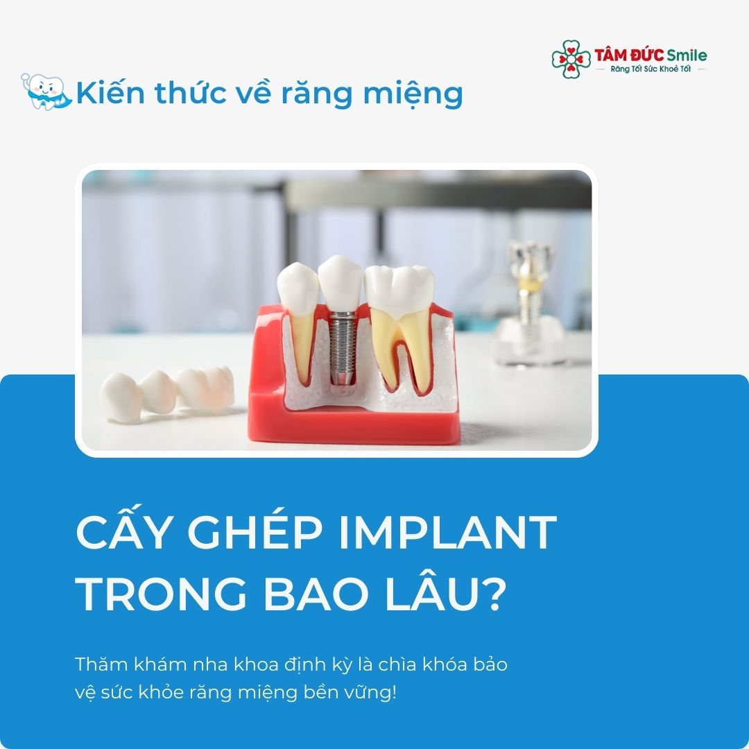 CẤY GHÉP IMPLANT TRONG BAO LÂU? ĐỊA CHỈ CẤY GHÉP IMPLANT UY TÍN