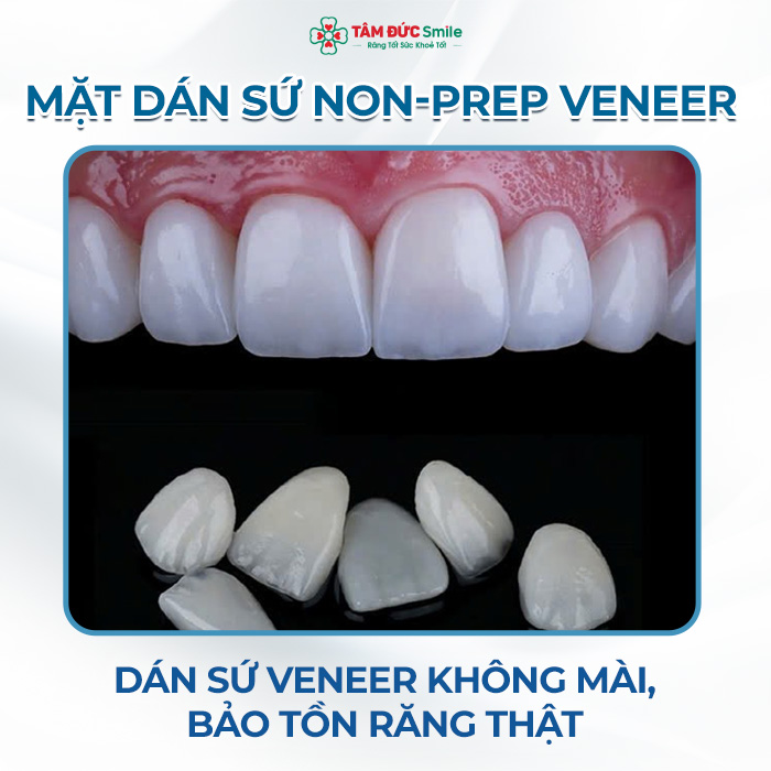 THẨM MỸ KHÔNG MÀI RĂNG VỚI NON-PREP VENEER: ƯU ĐIỂM, LƯU Ý VÀ ĐỊA CHỈ NHA KHOA UY TÍN
