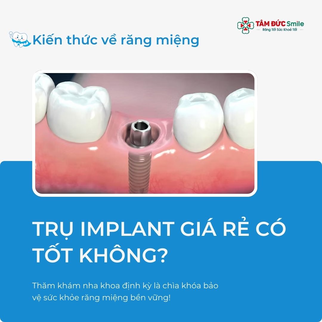 TRỤ IMPLANT GIÁ RẺ CÓ TỐT KHÔNG? NƠI TRỒNG RĂNG IMPLANT UY TÍN