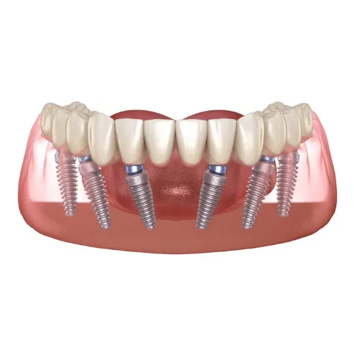 dv-implant-toan-ham