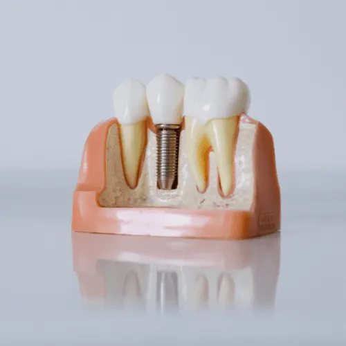 dv-trong-rang-implant