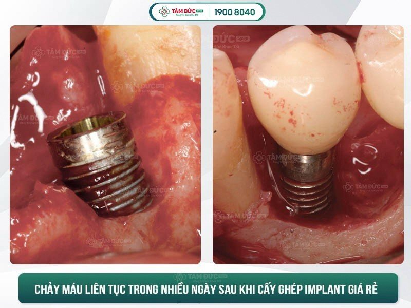 biến chứng implant sai cách