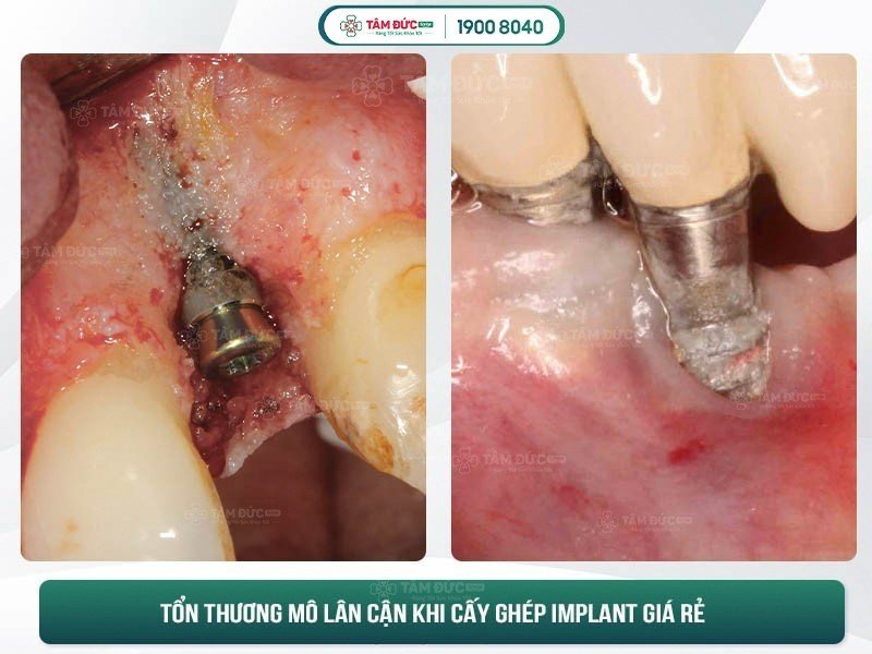 biến chứng implant tại địa chỉ kém chất lượng