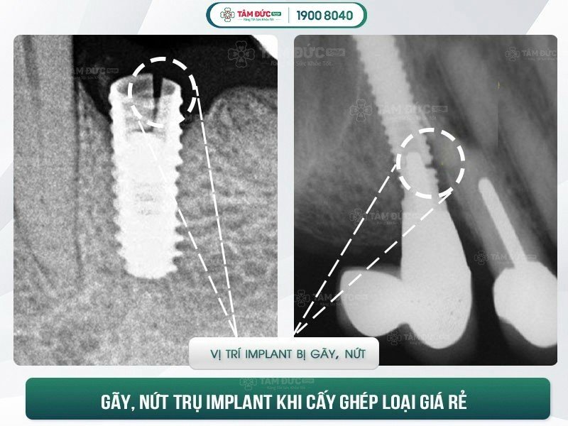 biến chứng implant làm gãy xương hàm