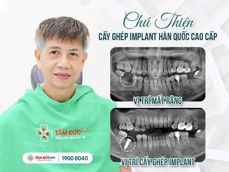 chú thiện cấy ghép implant tại tâm đức smile