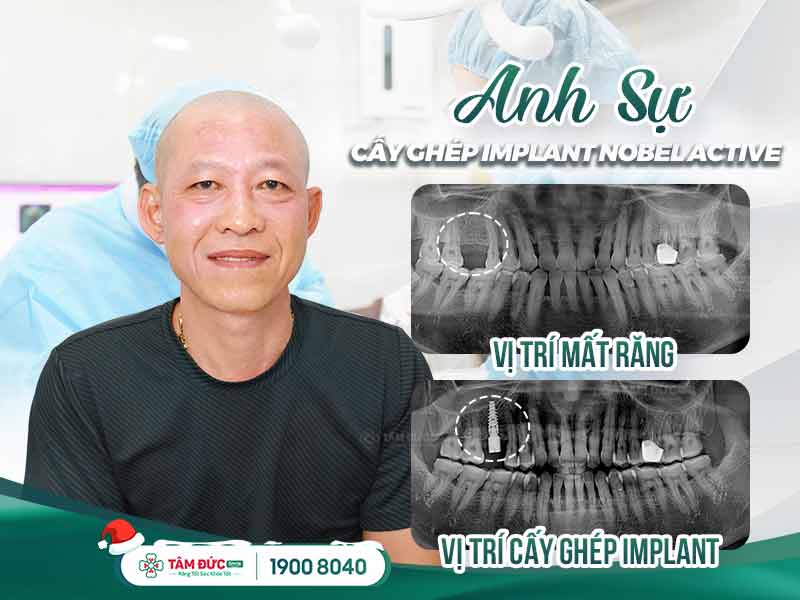 khách hàng trồng răng implant an toàn tại tâm đức smile