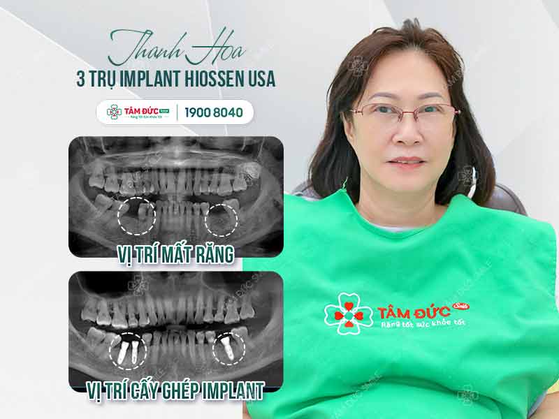 chị thanh hoa trồng răng implant tại tâm đức smile