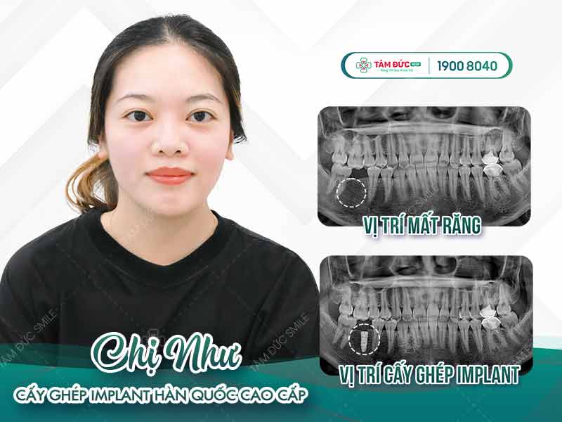 chị như cấy ghép implant tại nha khoa tâm đức smile