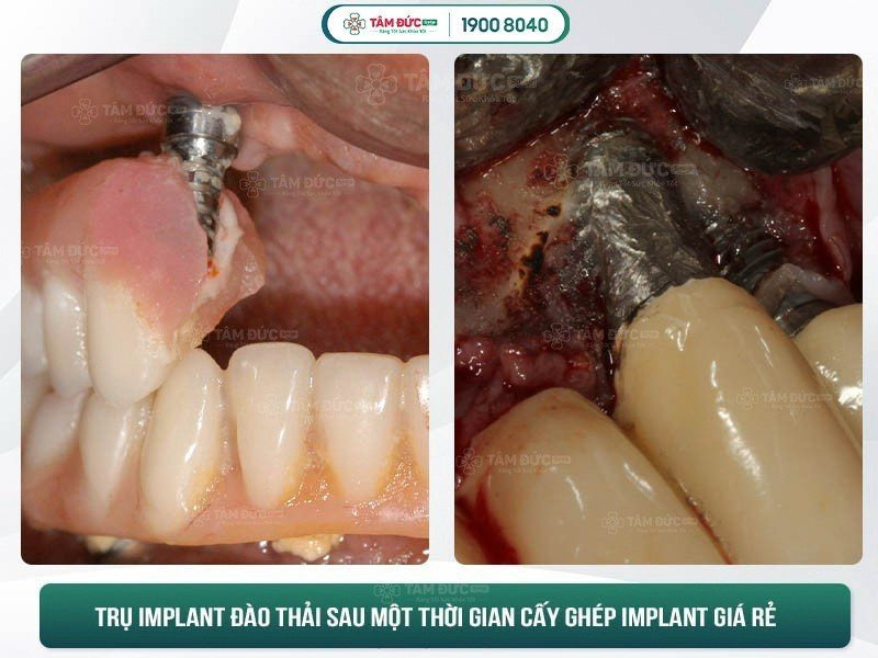 biến chứng implant sai cách