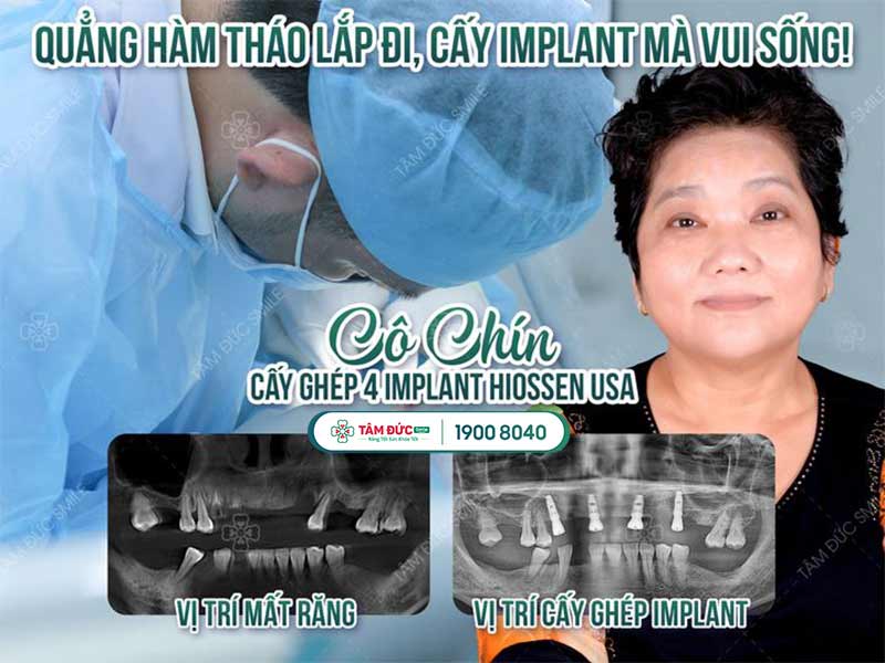 Ưu điểm của Implant All on 4 là giúp cô Chín lấy lại khả năng ăn uống