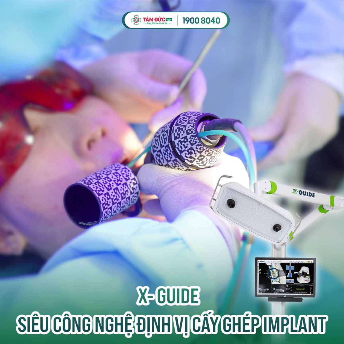 Nhiều nghệ sĩ Việt đã nhận ra ưu điểm của implant all on 4