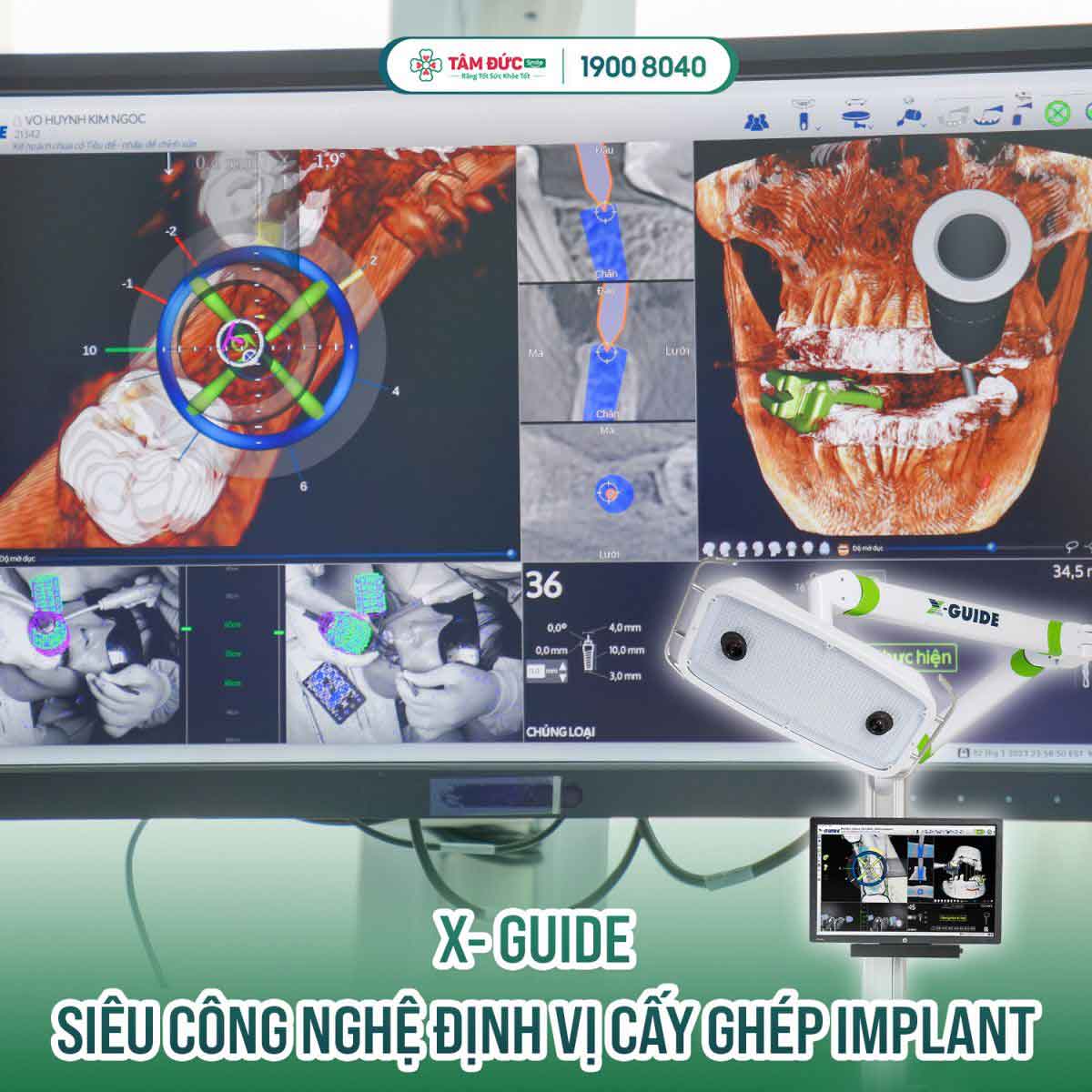 Cấy ghép Implant All on 4 đạt chuẩn tại Tâm Đức Smile