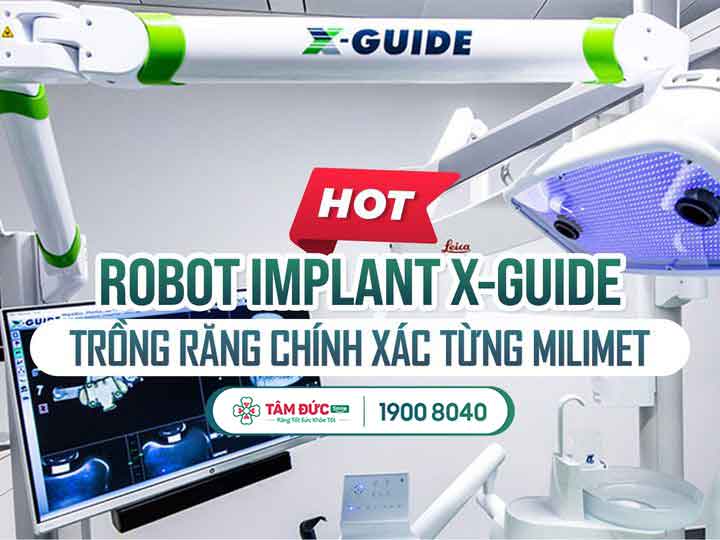 Máy X-Guide trong cấy ghép Implant All on 4