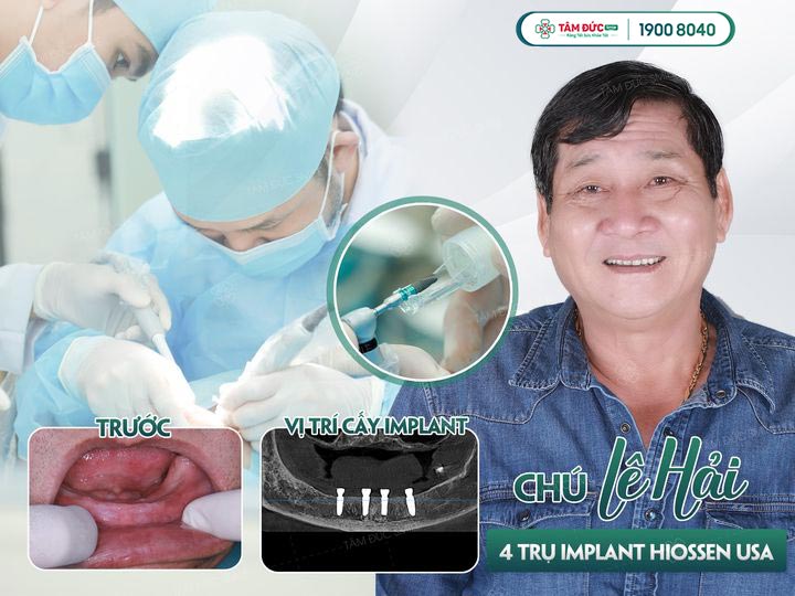 Chú Hải trước và sau khi cấy ghép implant all on 4