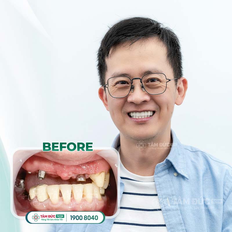 khách hàng cấy ghép Implant tại nha khoa Tâm Đức Smile