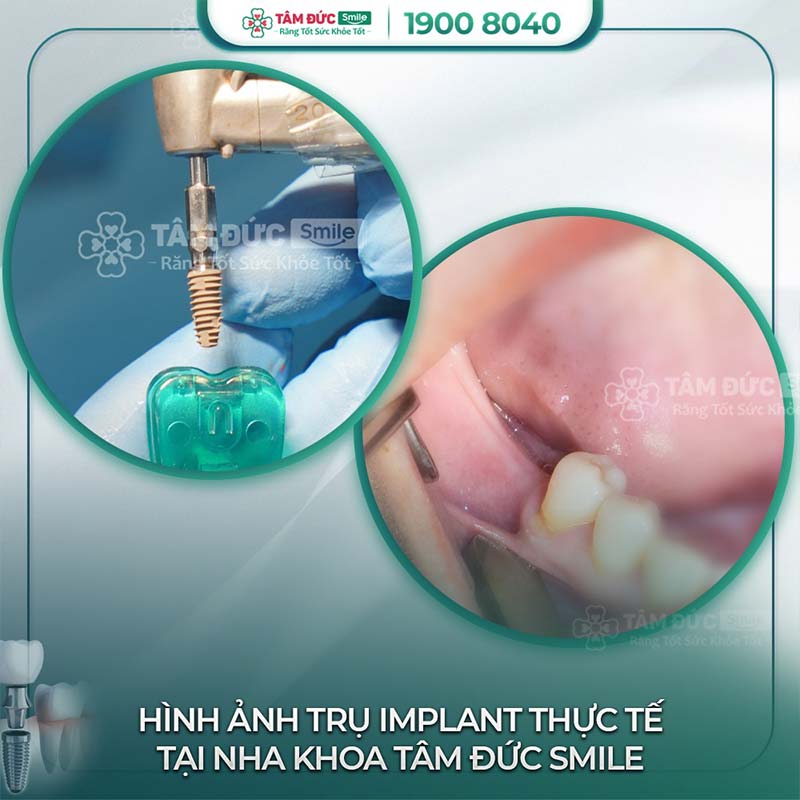 Nhổ răng trồng implant để loại bỏ nguy cơ áp xe răng tái lại