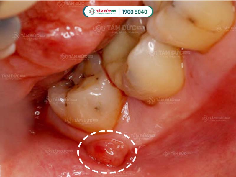 dấu hiệu nhận biết áp xe răng khôn