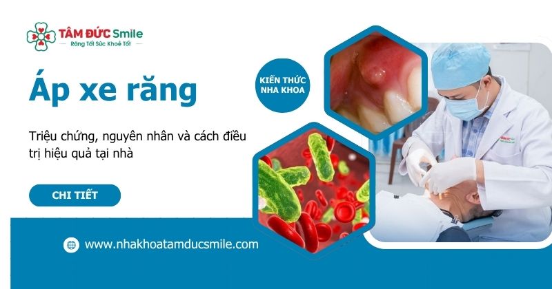Áp xe răng: Triệu chứng, nguyên nhân và cách điều trị hiệu quả tại nhà