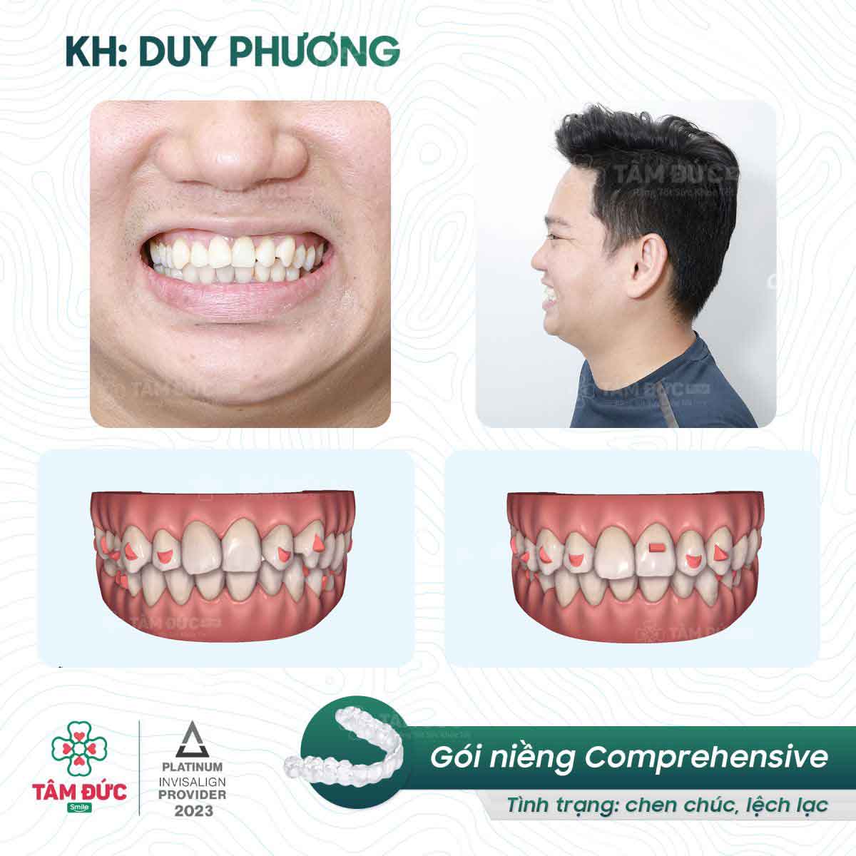 khách hàng niềng răng trong suốt tại nha khoa tâm đức smile