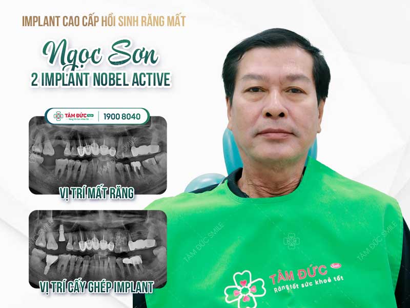 bảng giá trồng răng Implant tại nha khoa Tâm Đức Smile