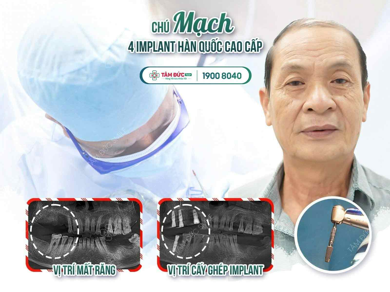 bảng giá trồng răng Implant tại nha khoa Tâm Đức Smile