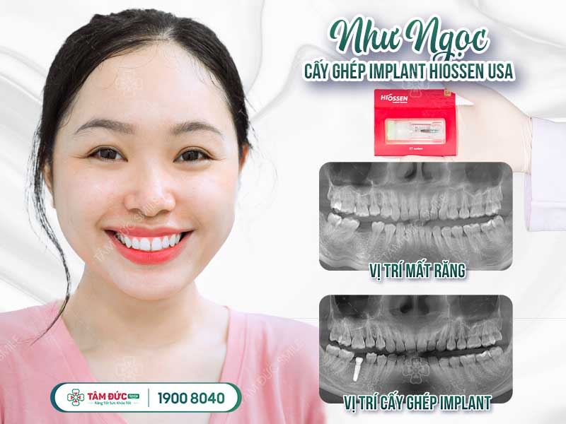 chị như Ngọc trồng răng Implant tại nha khoa Tâm Đức Smile