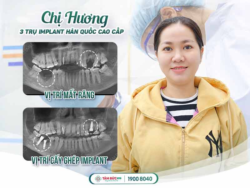 chị Hương trồng răng Implant tại nha khoa Tâm Đức Smile