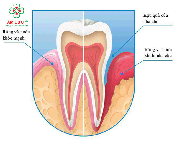 biện pháp chữa chảy máu chân răng hiệu quả