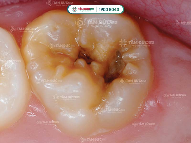 chân răng hàm bị sâu