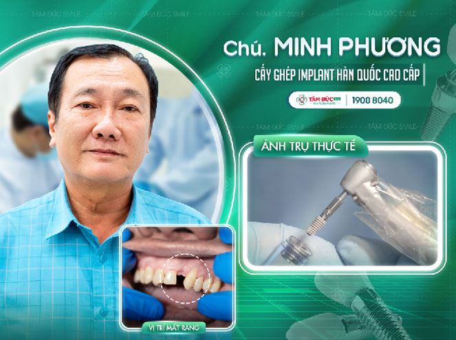 khách hàng bị gãy răng cửa điều trị bằng trồng răng Implant tại nha khoa Tâm Đức Smile