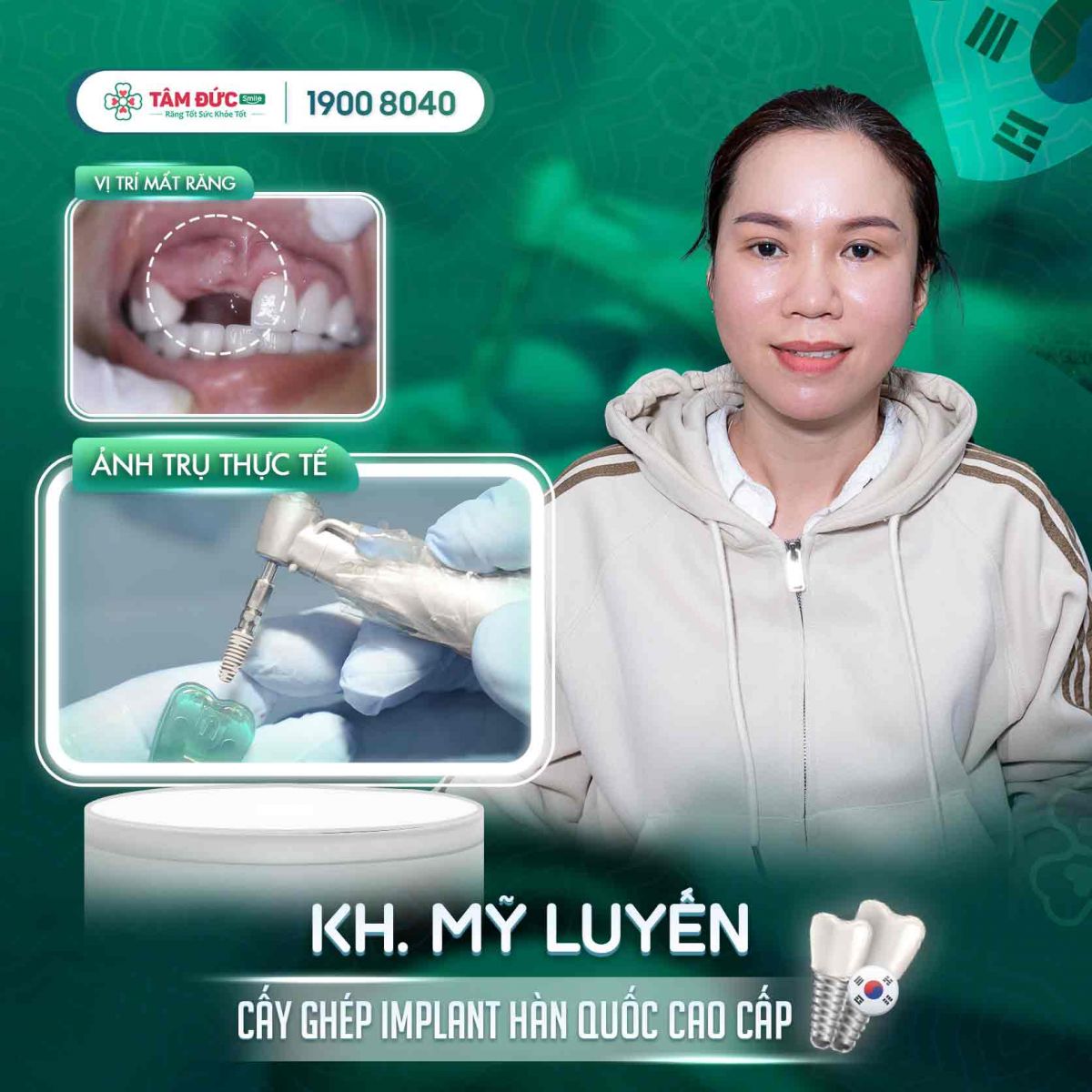 khách hàng bị gãy răng cửa điều trị bằng trồng răng Implant tại nha khoa Tâm Đức Smile