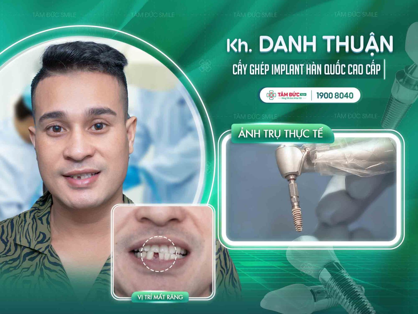 khách hàng bị gãy răng cửa điều trị bằng trồng răng Implant tại nha khoa Tâm Đức Smile