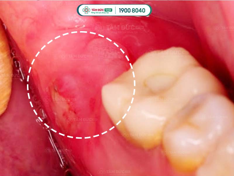 bị sưng nướu răng trong cùng