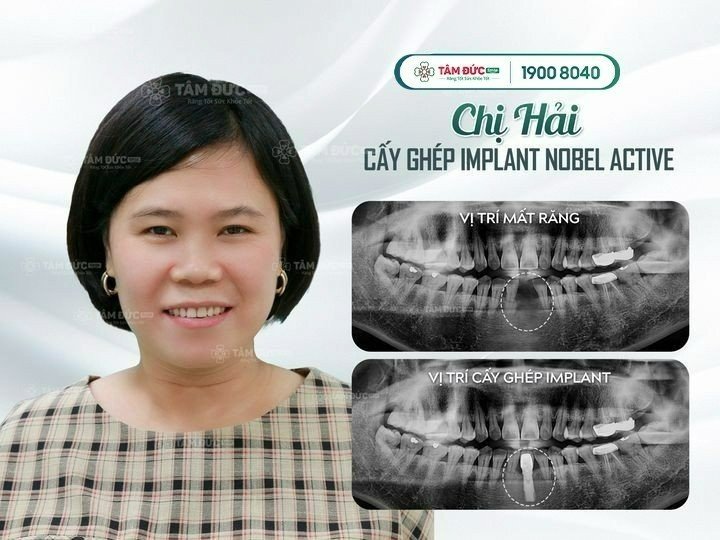 Chị Hải sau khi cấy ghép Implant tại nha khoa Tâm Đức Smile