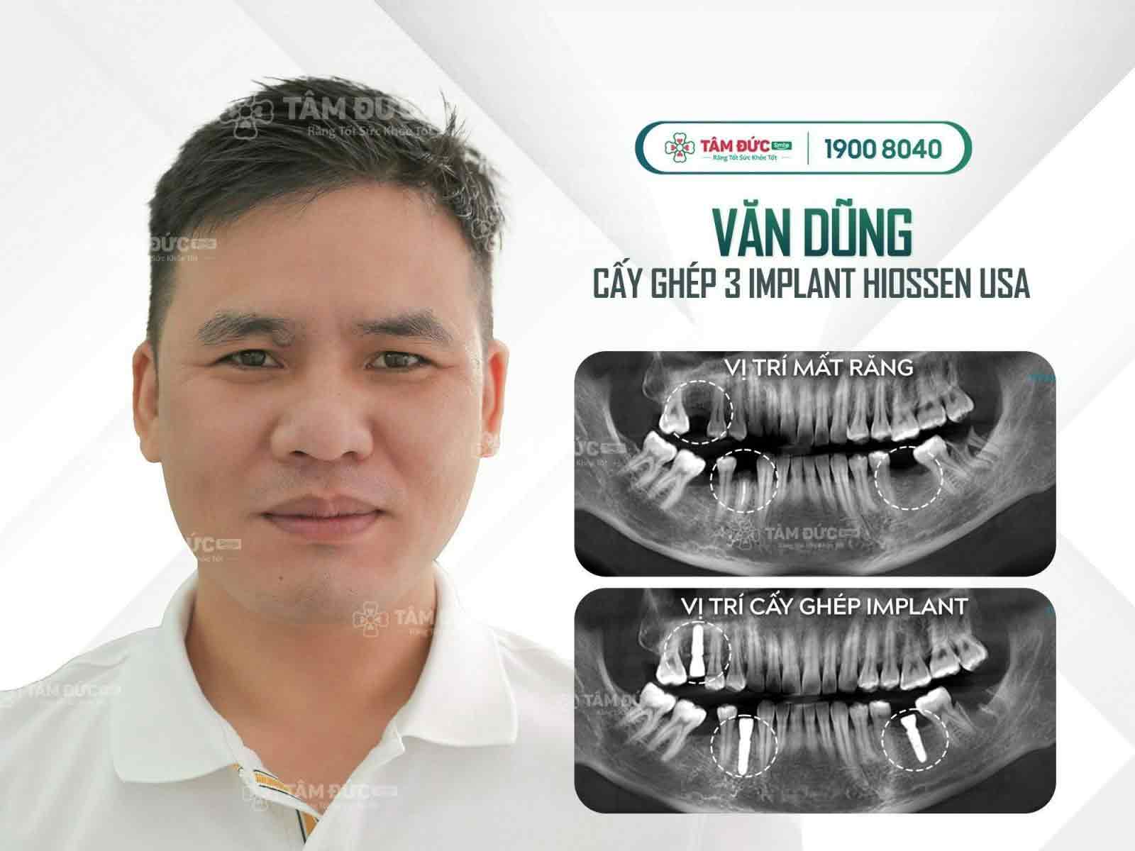 bị tiêu xương hàm có trồng răng được không