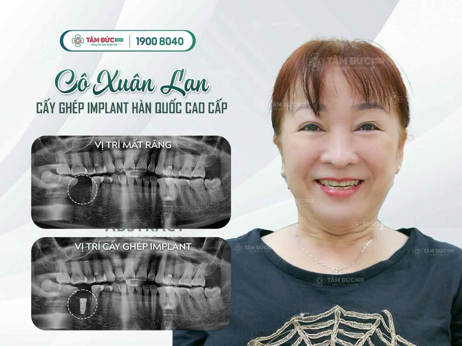 Cô Xuân Lan sau khi cấy ghép Implant tại nha khoa Tâm Đức Smile