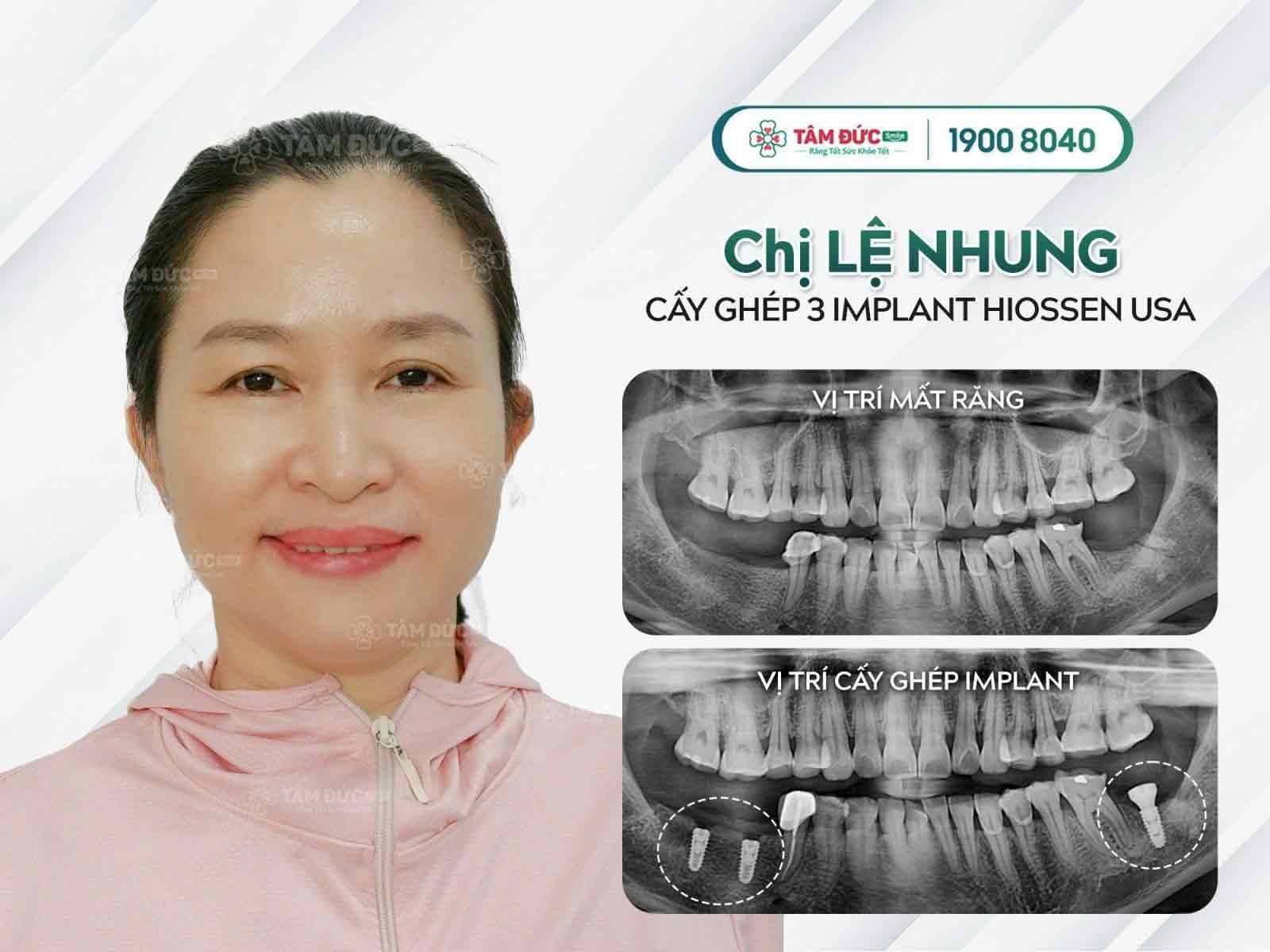 Chị Lệ sau khi cấy ghép Implant tại nha khoa Tâm Đức Smile