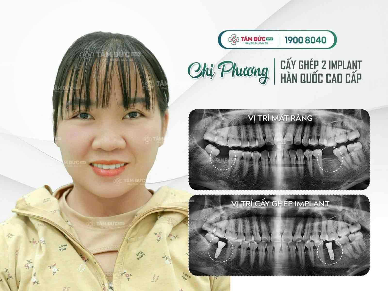 Chị Phương sau khi trồng răng Implant tại nha khoa Tâm Đức Smile