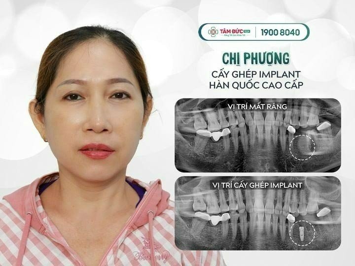 bị tiêu xương hàm có trồng răng được không