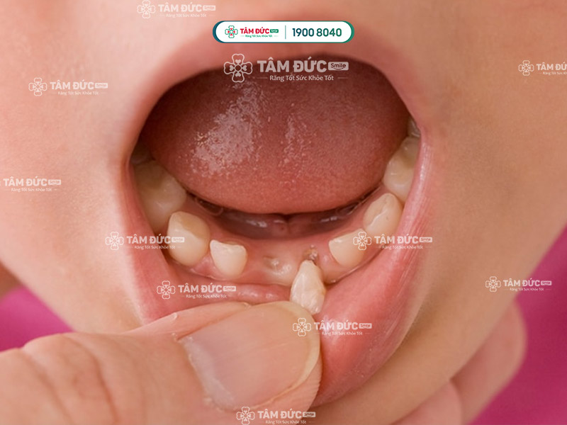 dấu hiệu răng lung lay ở bé