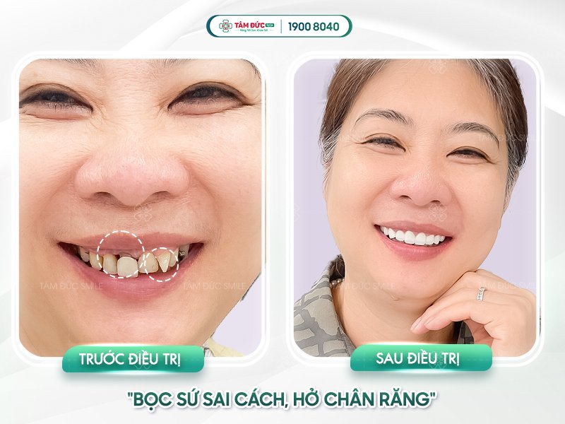 bọc răng sứ bị hôi miệng chảy máu chân răng phải làm sao