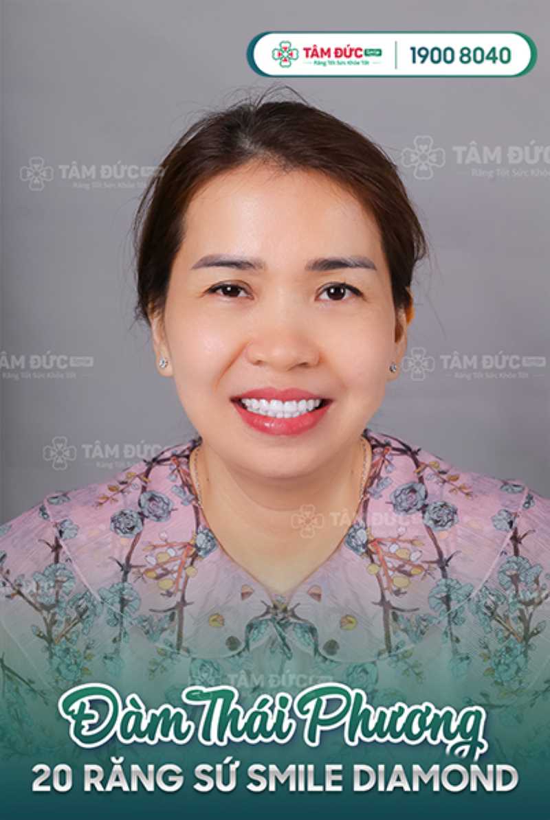 bọc răng sứ smile diamond