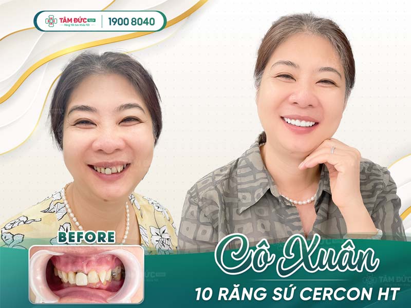 bọc răng sứ có tốt không