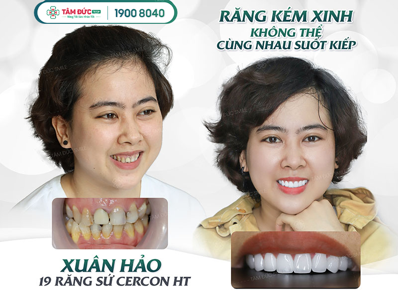 bọc răng sứ ở đâu tốt