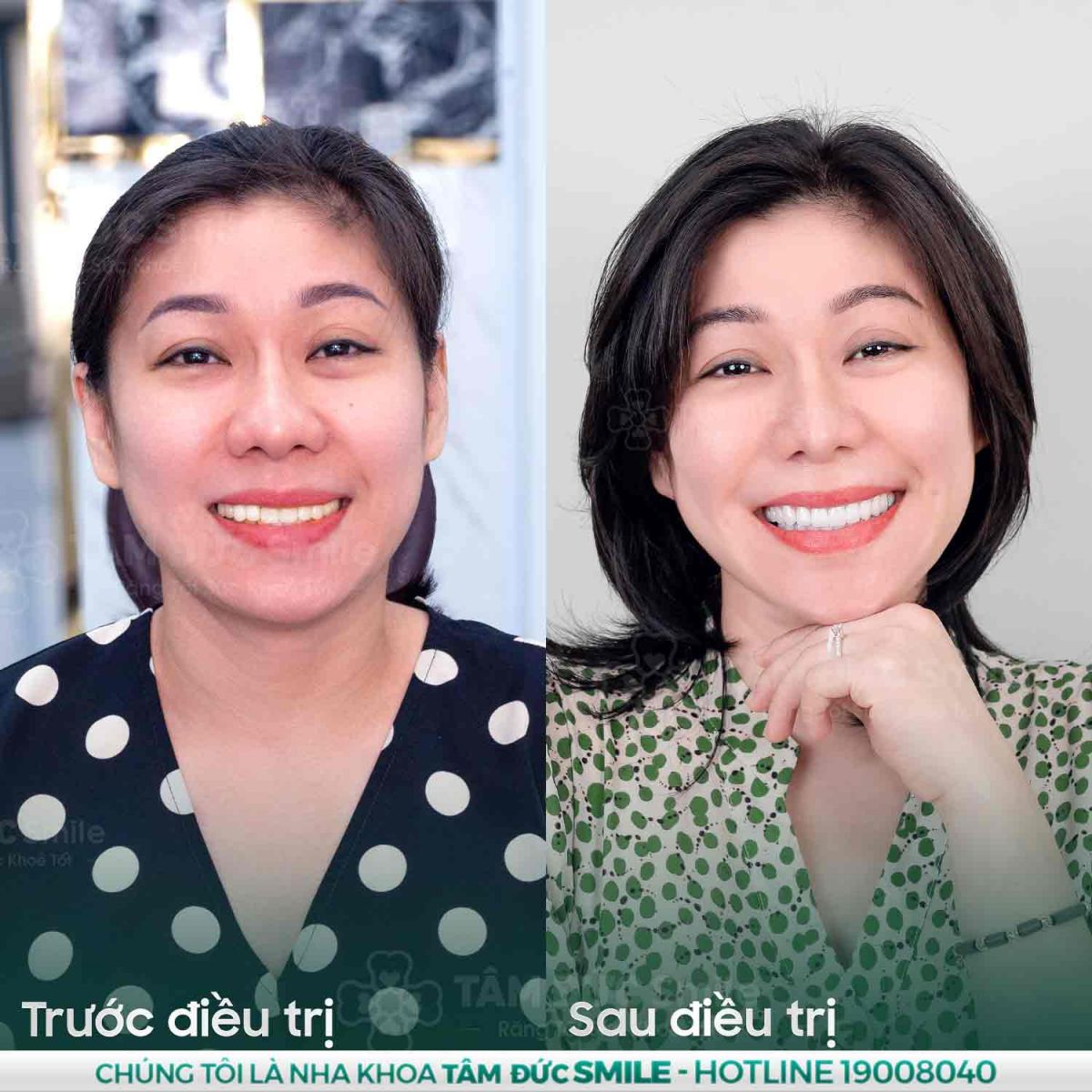 bọc răng sứ tại nha khoa tâm đức smile