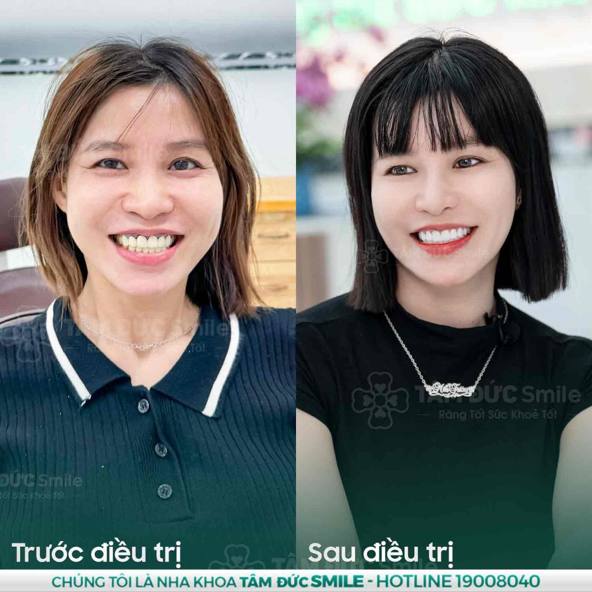 bọc răng sứ tại nha khoa tâm đức smile