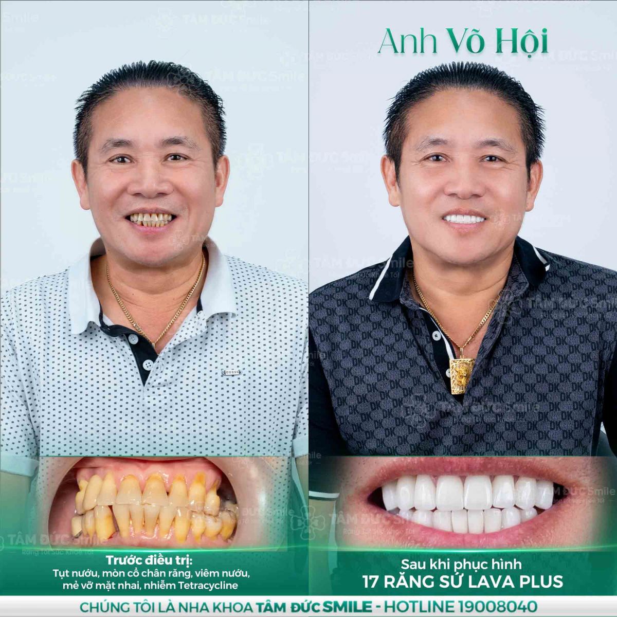 bọc răng sứ tại nha khoa tâm đức smile