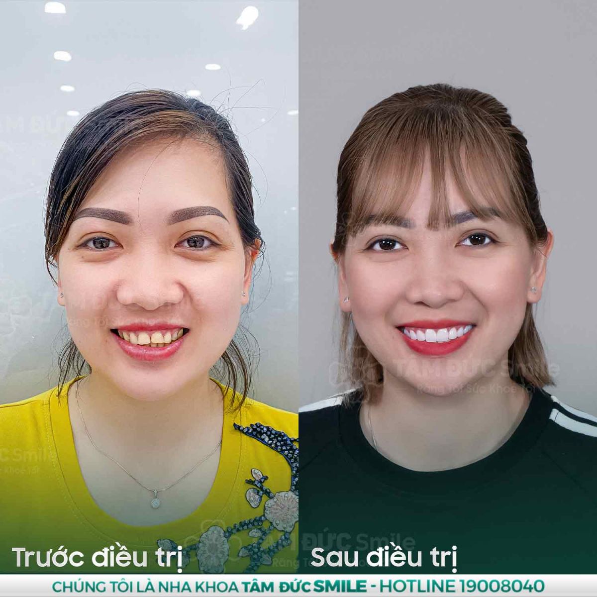 bọc răng sứ tại nha khoa tâm đức smile