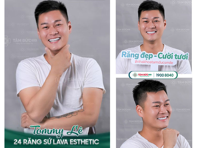 anh Tommy Lê sau khi bọc răng sứ trả góp tại nha khoa Tâm Đức Smile