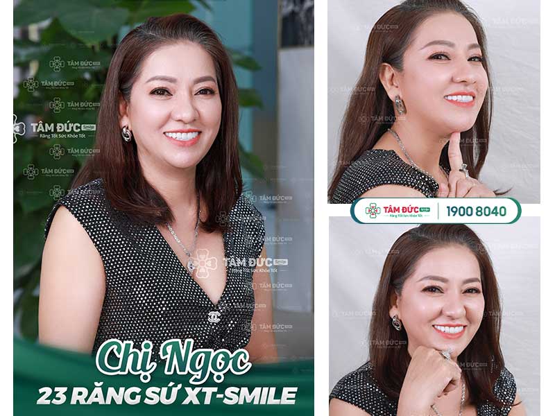 Chị Ngọc sau khi bọc răng sứ tại nha khoa Tâm Đức Smile